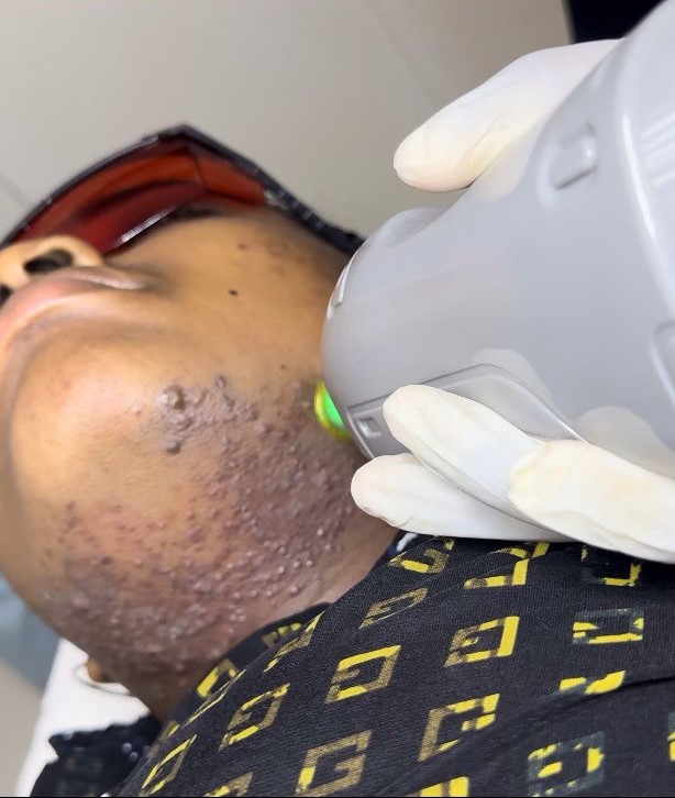 Laser Treatments