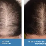 prp-hair