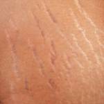 stretchmark